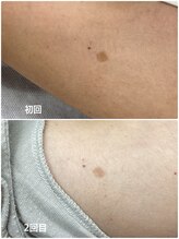 ヒカリ(Hikari)/腕もできます♪