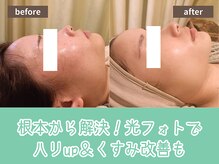 キザシ(kizashi)/最新機器【超リフト】でシワ改善