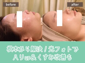 キザシ(kizashi)/最新機器【超リフト】でシワ改善