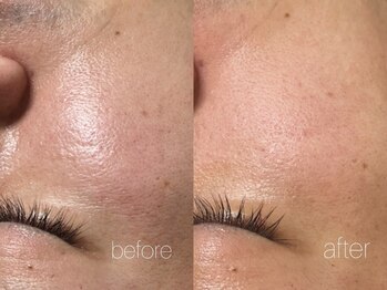 エムフロート(M float)/ハーブピーリング|毛穴