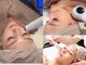 グラシアス サロン(GRACIAS SALON)の写真/深層温熱×表情筋リフトでほうれい線をケア。立体的な小顔とハリ弾力UPへ。