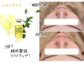 キレイベース 銀座店(KIREI BASE)/レモンボトル 1回での変化