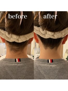 ミノア 大野城店(MINOA)/うなじ脱毛MW型ビフォーアフター