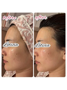 レティシア(Leticia)/◇ラミネーションピーリング◇