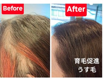 かこ鍼灸院の写真/もう周りの目をきにしなくていい！自分の力で自然と髪の毛が生えるように！広島/育毛促進/鍼灸/中区/肩こり