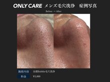 オンリィケア 関大前(ONLY CARE)/【メンズ毛穴洗浄】