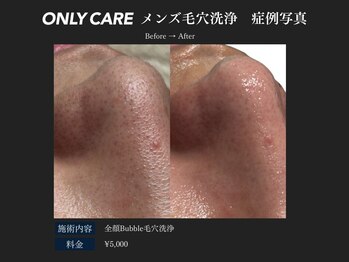 オンリィケア 関大前(ONLY CARE)/【メンズ毛穴洗浄】
