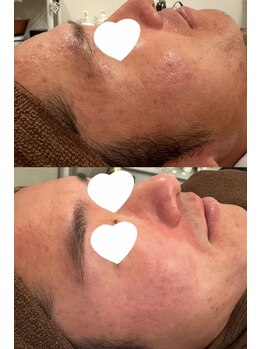 ミベル フェイシャルサロン(MIBELL FACIAL SALON)/お客様症例★メンズ