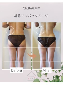 チュラ鍼灸院 西宮北口(ChuRa鍼灸院)/小尻・美尻・下半身太り解消