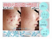 ホワイトアクア 加古川店(WHITE AQUA)/ララピール/兵庫/加古川/毛穴