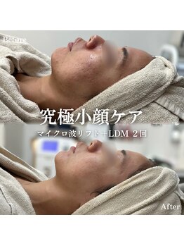 イロハ(IROHA)/2回の施術効果◎