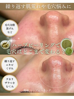 ソユ(SOYOU)/施術* ハーブピーリング