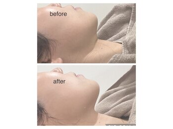 グリシーヌ(GLYCINE)/顎下もスッキリ★