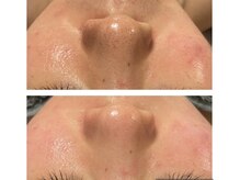 リリーココ(Lily Coco)/毛穴黒ずみ、ざらつき