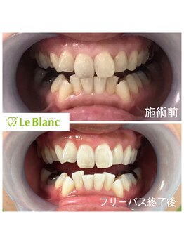ルブラン 奈良店(Le Blanc)/3週間で綺麗にトーンアップ♪