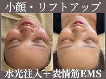 マヴィ くずは店(MavY.)の雰囲気（最先端☆水光注入×筋膜リリース。1回で驚きの結果に。）
