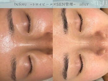 スキンラボアメリ(skin lab. ameri)/お悩み…赤黒さ繰り返すトラブル