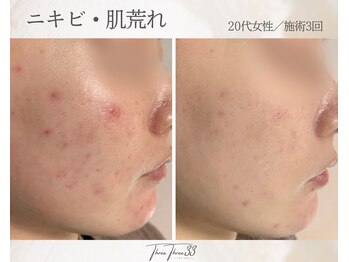 スリースリー(THREE THREE)/ニキビ・肌荒れ