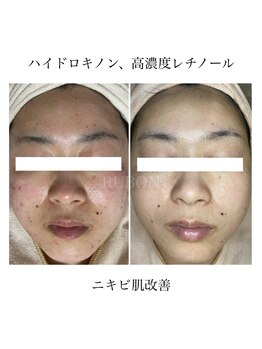 ルボン 宮崎店(RUBON)/RUBON得意とするニキビ改善症例