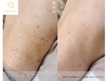 スキニティ 池袋(sknity)/<背中>自分では見えない背中ケア