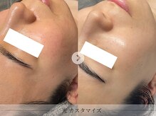 スパレーカ(Spa laka)/赤み・凹凸ケア