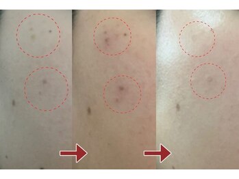 夢花/シミケアのビフォー&アフター