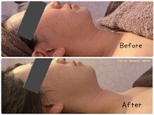 エレクトロポレーション導入でスッキリ小顔に！美肌効果も抜群！