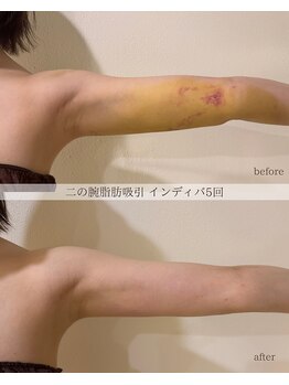 ブラン(blanc)/術後インディバ5回