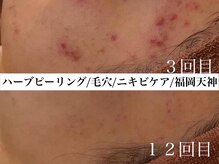 ホワイトアクア 福岡天神店(WHITE AQUA)/ハーブピーリングビフォー