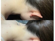 リエラ(Liella)/【うなじ脱毛】