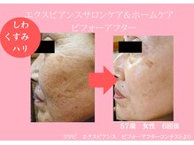 ソフィア ミューズ 目黒/目黒エステで水光ピーリング