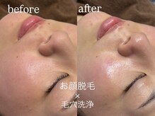 エーアール(ar)/お顔脱毛×毛穴洗浄