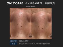 オンリィケア 関大前(ONLY CARE)/【メンズ毛穴洗浄】