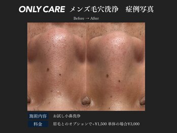 オンリィケア 関大前(ONLY CARE)/【メンズ毛穴洗浄】