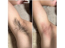 エステ リラクゼーションサロン(more)/【男性】脇スキンケアWAX脱毛