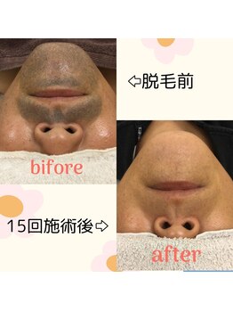 バルミー(Balmy)/ヒゲ脱毛