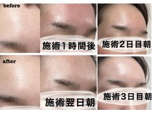 ベガ(Vega)/ダウンタイム経過