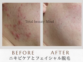 トータルビューティー マインド(Total Beauty)/ニキビケアとフェイシャル脱毛