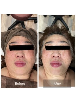 プリューム(PLUME)/小顔矯正