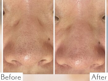 ディオーネ 上越南高田店(Dione)/毛穴洗浄&顔脱毛