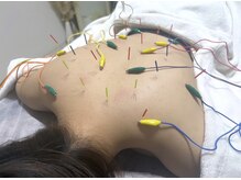 エムフロート(M float)/ハーブピーリング｜ニキビ