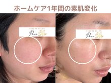 ポノ(Pono)/毛穴が目立ちにくい素肌へ☆