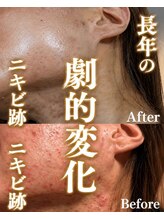 エレ(ele)/首元ニキビまでハーブピーリング