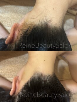 レーヌ(Reine)/うなじえりあし脱毛