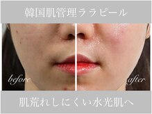 アリスビューティー(AliceBeauty)/韓国肌管理ララピール