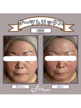 ビーマジック(美magic)/サーマトリックス