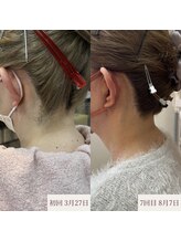 クラームビューティー(Clerm beauty)/美容師によるうなじデザイン脱毛