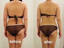 ヴィセラ(Vicella)/ブライダルで背中出すので…