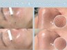 【濃く目立つシミケア/毛穴汚れ】光フォト＋シミ集中ケア＋毛穴クレンジング
