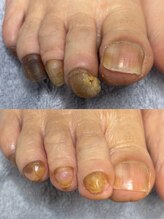 リゼラアンドコー 柏原店/長年悩まれたお爪